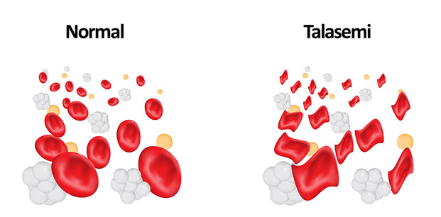 TALASEMİ (AKDENİZ ANEMİSİ) TESTİ